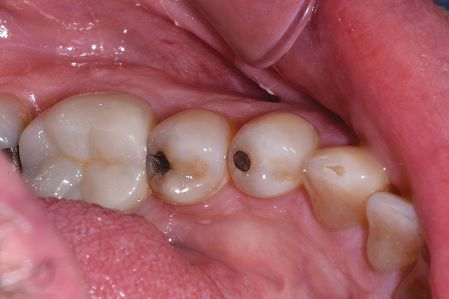 Novel Dental Composite Systems Can Help Practices Achieve Efficiency